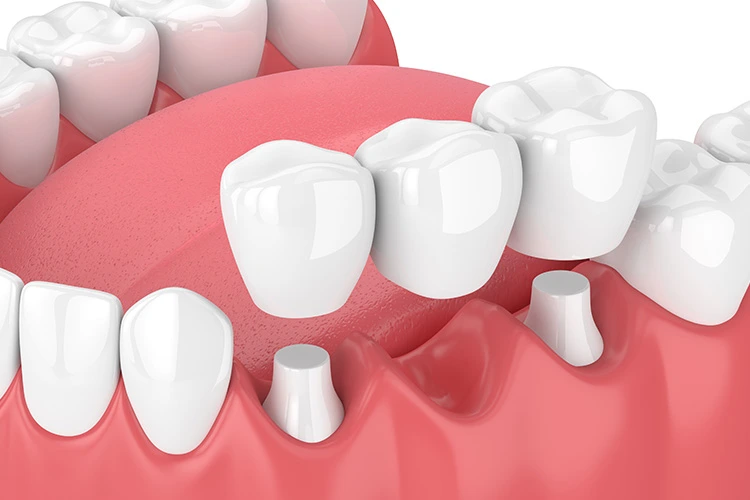 Restorative dentist in Port Coquitlam at Shaughnessy Square Dental Centre