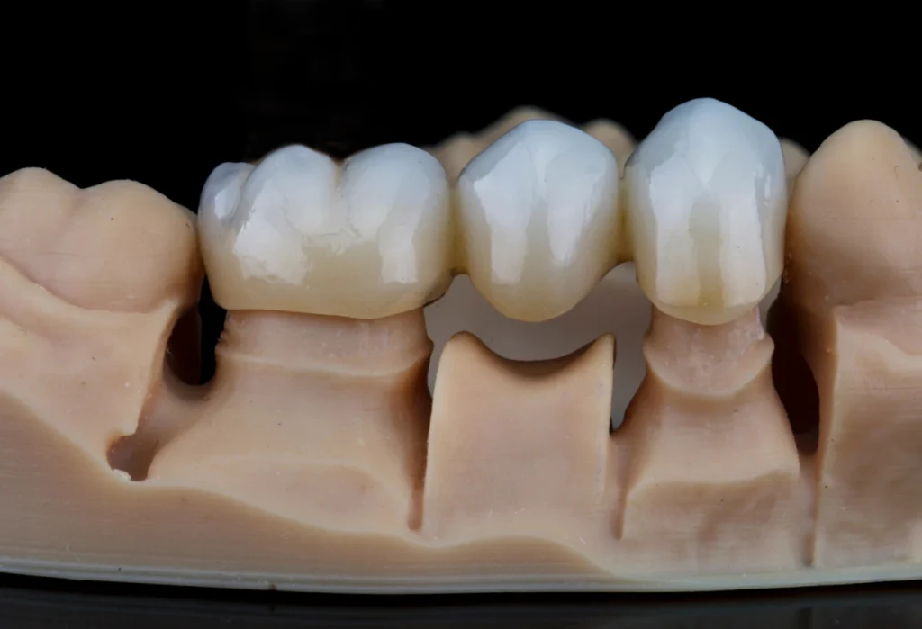 Dental crowns and bridges in Port Coquitlam at Shaughnessy Square Dental Centre
